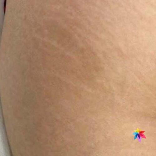 Stretch Mark After