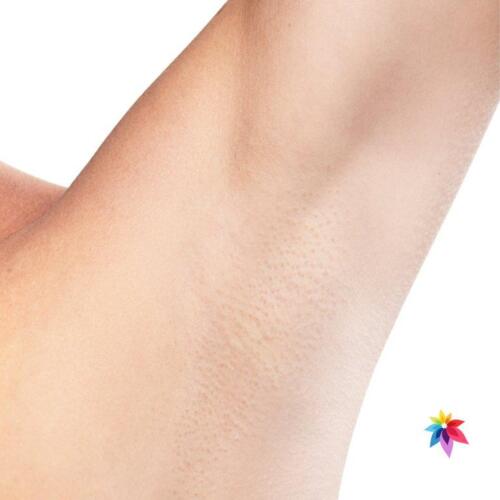 laser hair removal - after