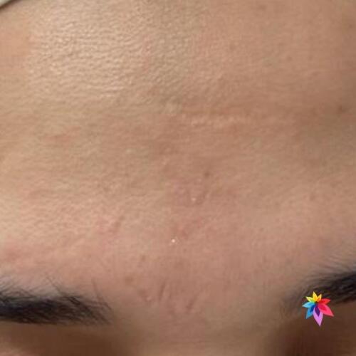 scar Treatment After