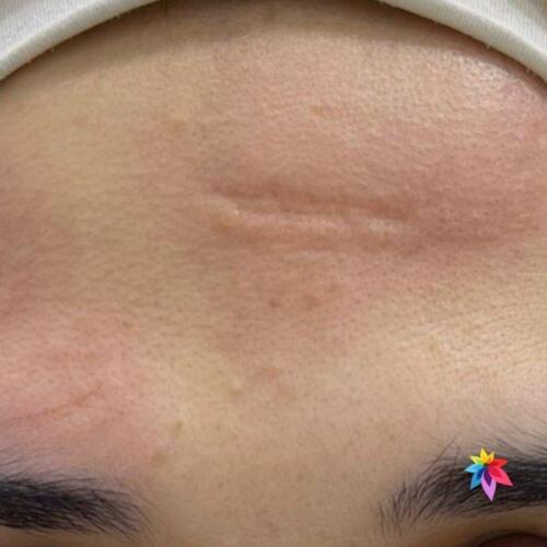 scar Treatment Before