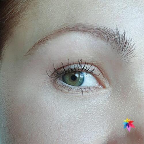 undereye treatment - After